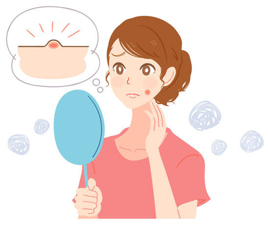 ニキビに悩む女性