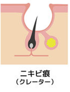 ニキビ跡（クレーター）