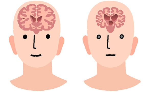 認知症の人の脳の萎縮